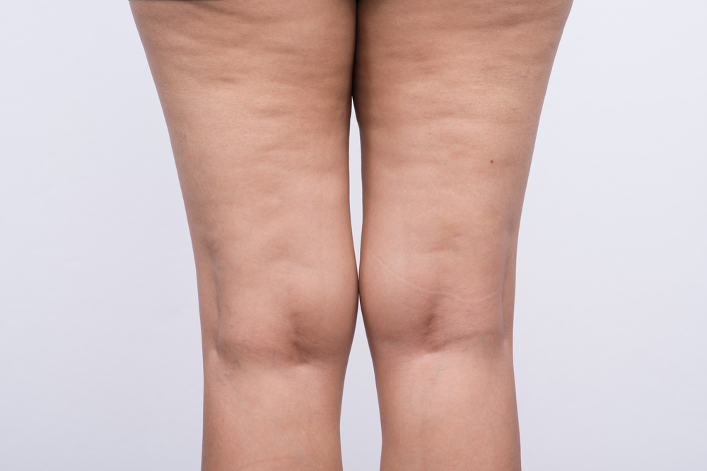 Could The Presence Of Cellulite Indicate Disease Your Total
